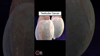 Symptoms of Testicular Cancer [upl. by Salis691]