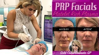 PRP quotVampirequot Facials  First Treatment  Before amp After  Analysis [upl. by Tori820]