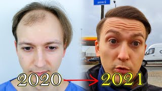 FUE Hair Transplant Growth Timeline  Before amp After [upl. by Bitthia67]