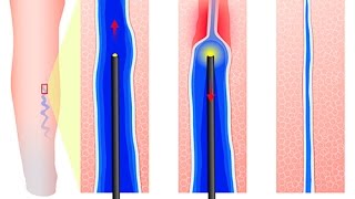 Comment se soignent les varices [upl. by Ynez499]