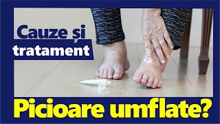 Picioare UMFLATE Cauze și Tratament [upl. by Peta]